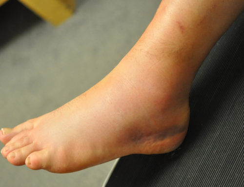 Ankle Sprains in GAA players