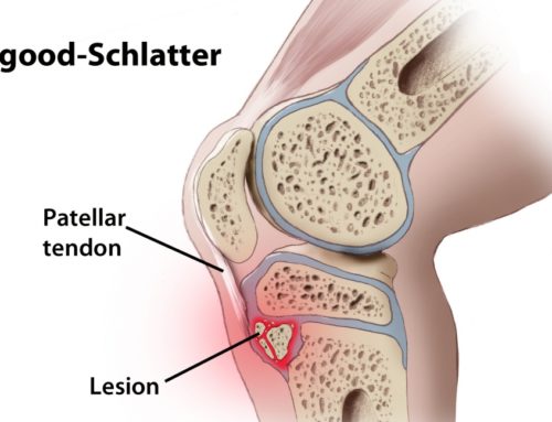 Is Osgood-Schlatter Disease causing my child’s knee pain?