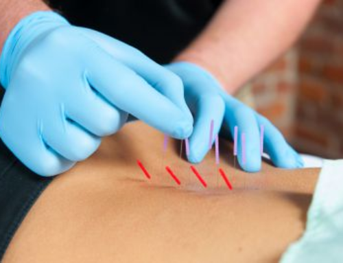 Would Dry Needling Help Me?