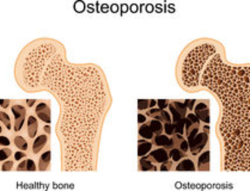 Osteoporosis and Physiotherapy