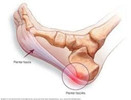 Could I have Plantar Fascitis/Fasciosis?