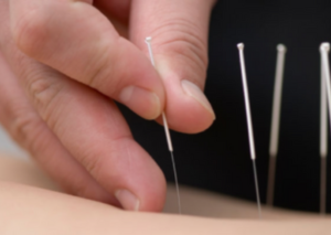 needling