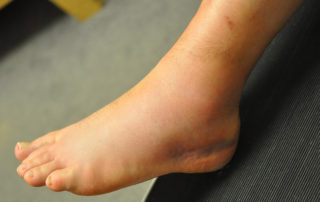 Ankle Sprains in GAA players