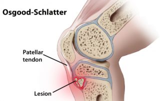 Osgood-Schlatter Disease